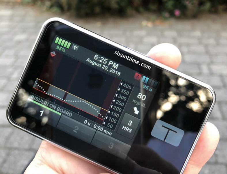 Control-IQ: noua tehnologie care ajuta la controlul diabetului de tip 1