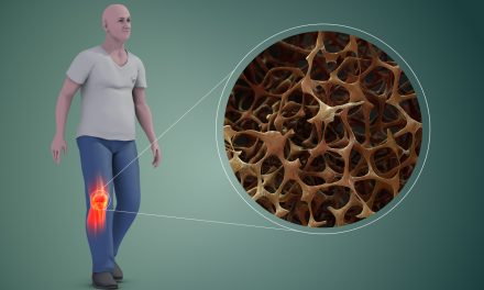 Ce trebuie să știm despre osteoporoză și cum o prevenim?
